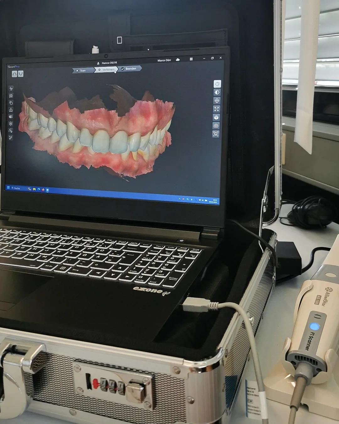 Ein Laptop zeigt eine 3D-Visualisierung von Zähnen und Zahnfleisch auf dem Bildschirm, neben einem Zahnarztscanner.